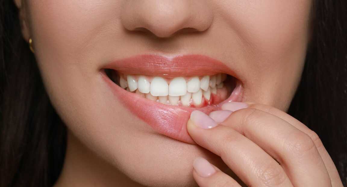 Mit tehetünk, ha vérzik a fogíny fogmosást követően?