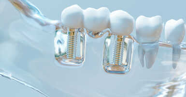 fogimplantátum beültetése után